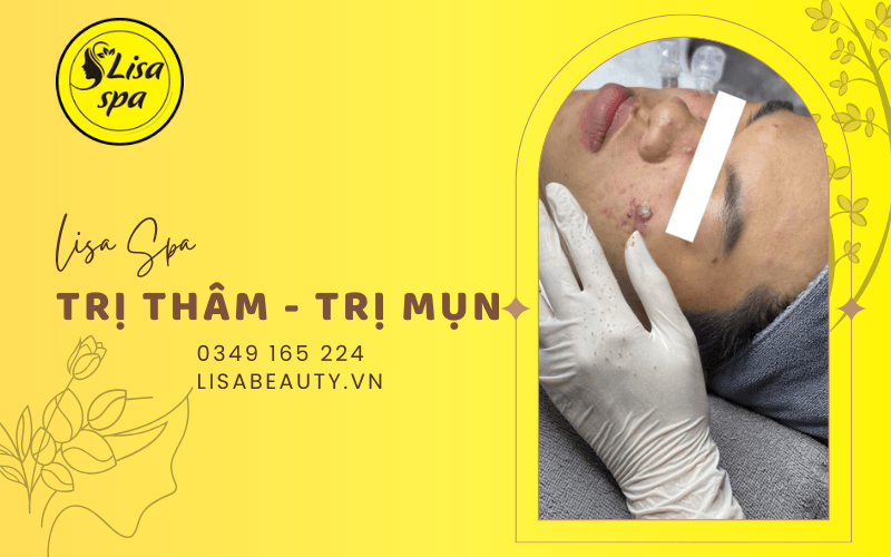 trị mụn trị thâm