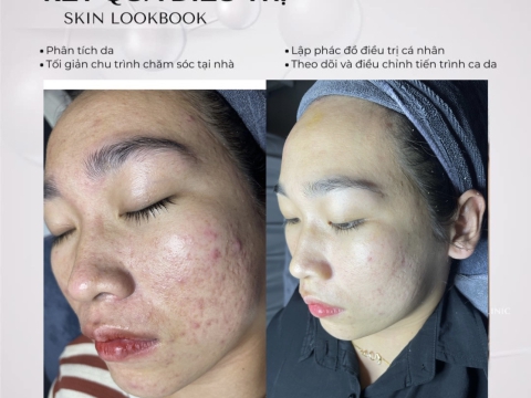 KẾT QUẢ ĐIỀU TRỊ SKIN LOOKBOOK