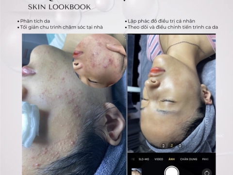 QUÁ TRÌNH ĐIỀU TRỊ SKIN LOOKBOOK