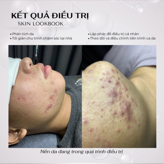 Kết quả sau liệu trình 5