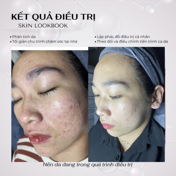 KẾT QUẢ ĐIỀU TRỊ SKIN LOOKBOOK